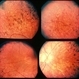 retinitis pigmentosa